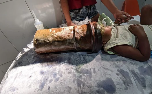 Menino de 2 anos é resgatado após ficar com a cabeça presa em tubo de metal em AL